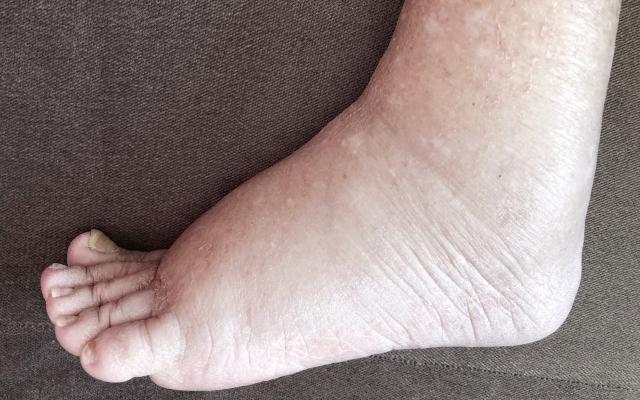 Een voet met oedeem.