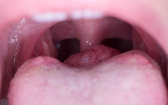Een zwelling op de tongbasis.