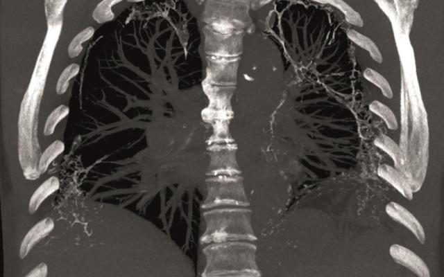 CT-scan van de thorax.