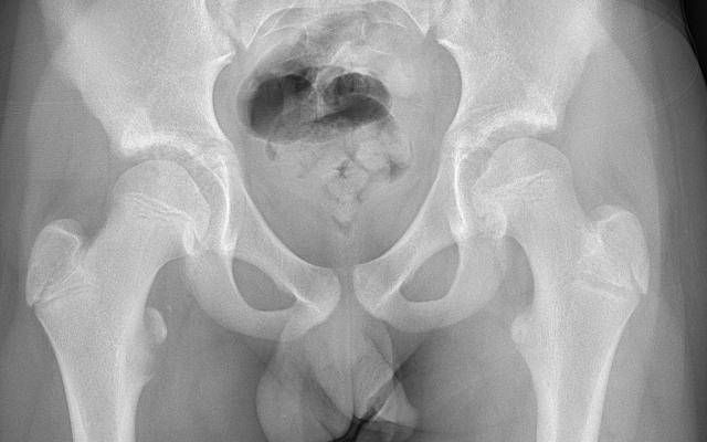 Röntgenfoto van de heupgewrichten.