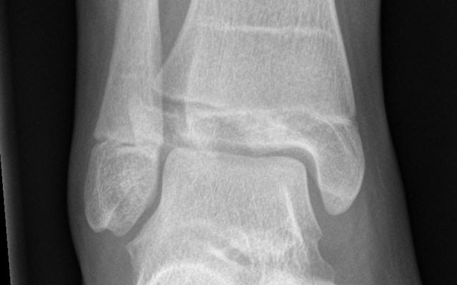 Röntgenfoto van de enkel.
