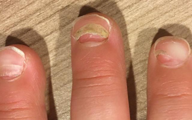 Loslatende nageltjes.