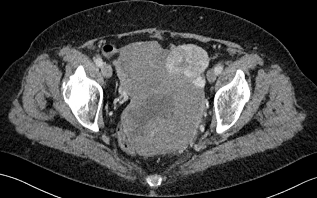 CT van het abdomen.