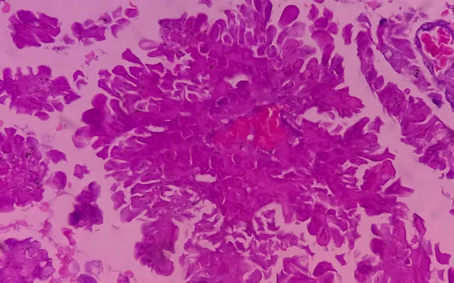 hersencarcinoom