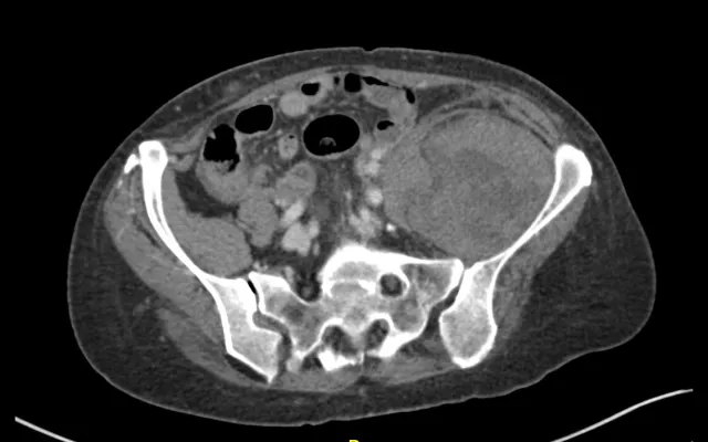 CT-angiogram van het abdomen.