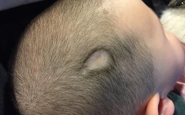 Een baby met een kale plek op het hoofd