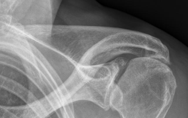 Röntgenfoto van de schouder.