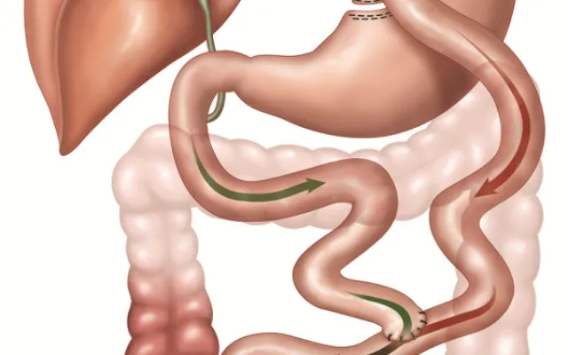 Illustratie ter verduidelijking van bariatrische chirurgie.