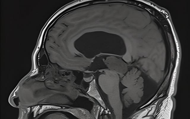 MRI-scan van hersenen. Hierop is een massa zichtbaar ter hoogte van de pinealisregio met compressie op het aquaeductus cerebri met dilatatie van het supratentoriële ventrikelsysteem. 