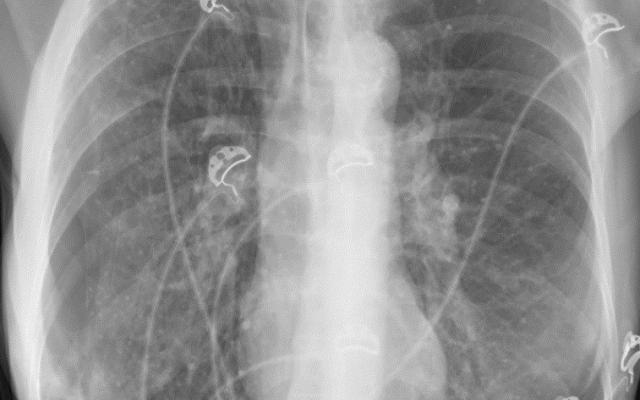Röntgenfoto van een ribbenkast. 