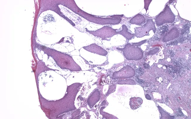 Microscoopfoto van een coupe van een biopt.