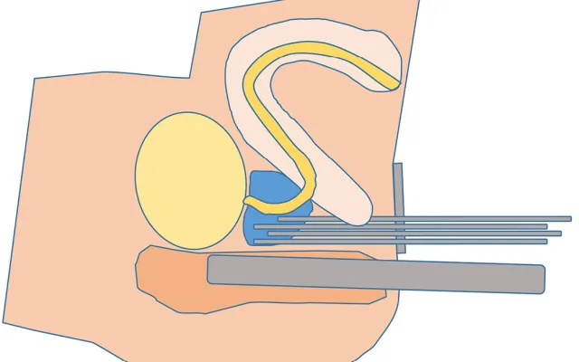 Schematische weergave van de plaatsing van de brachytherapie-katheters.