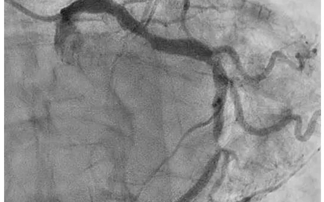 Angiogram van de A. coronaria sinistra.