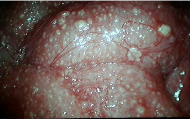 Voorbeeld van het sterrenhemelaspect tijdens een laparoscopie, een diffuus beeld van een peritonitis met verspreid in het abdomen multipele witgele spikkels.