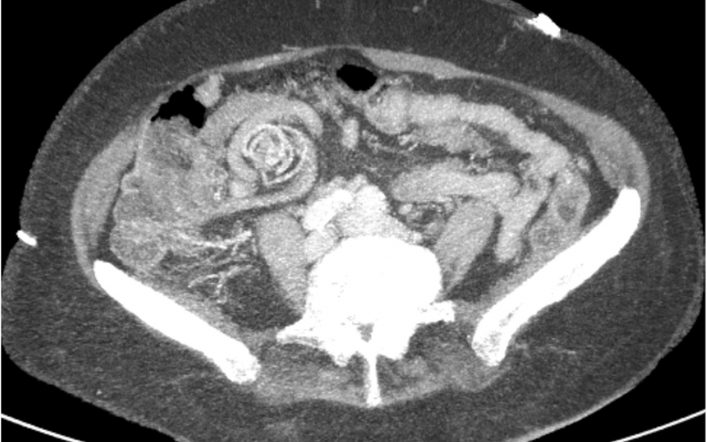 CT-angiogram