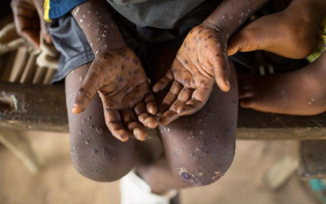 Ledematen bedekt met blaasjes op de huid.