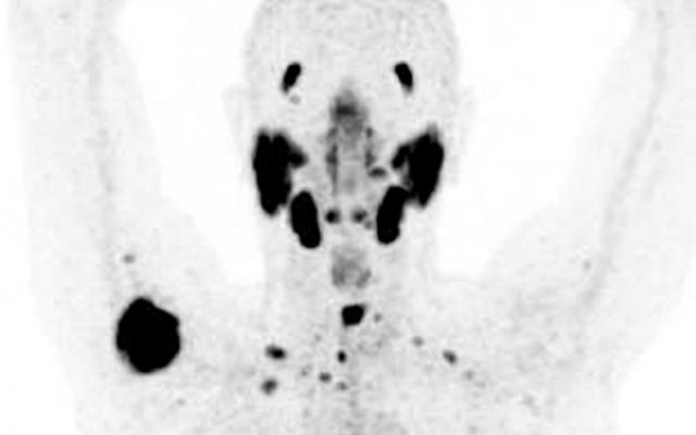 PSMA-PET-scan