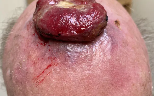 Een bloedende tumor op het hoofd.