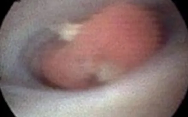 Ductoscopie beeld