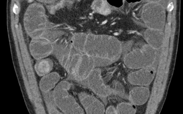 Röntgenbeeld van darmen