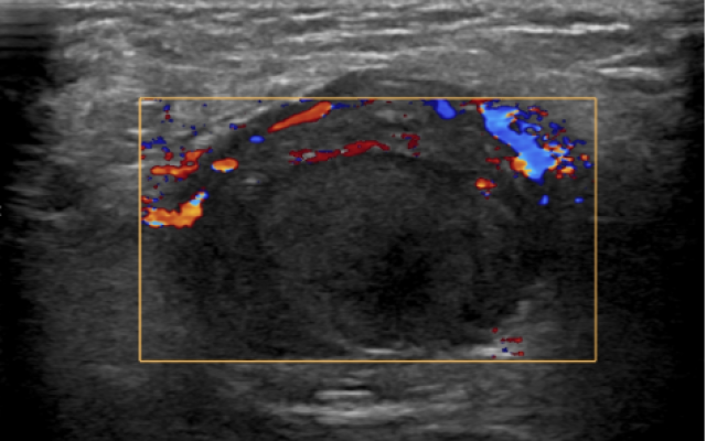 Doppler-echo van een lies.