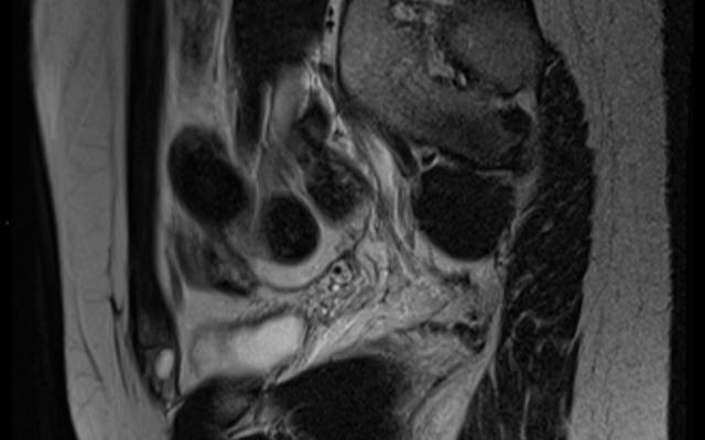 Röntgenbeeld van onderbuik