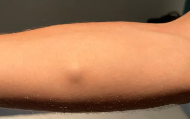 Arm met zwelling