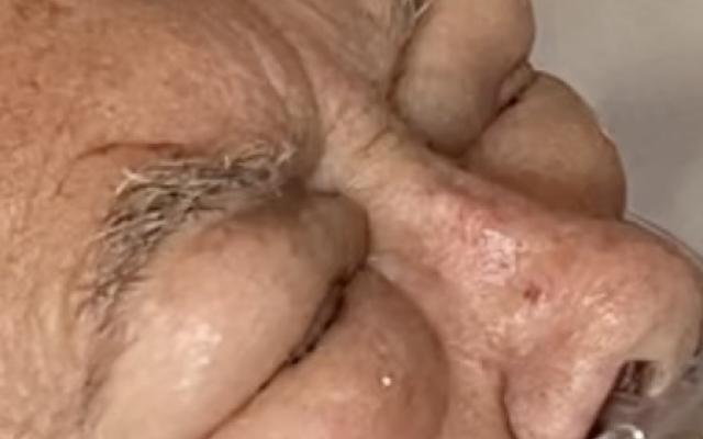 Man met gezwollen ogen