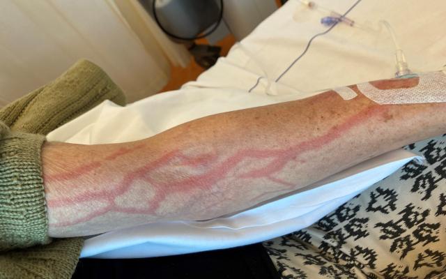 Een onderarm met allemaal huiduitslag in het verloop van de venen.