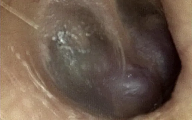 Trommelvlies ingezoomed.