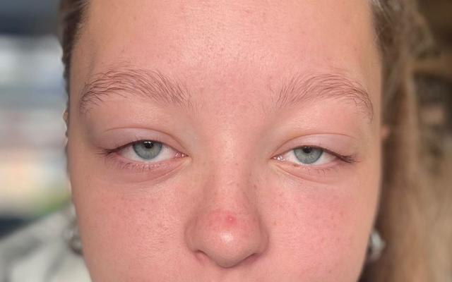 Een meisje met oedeem van de bovenoogleden