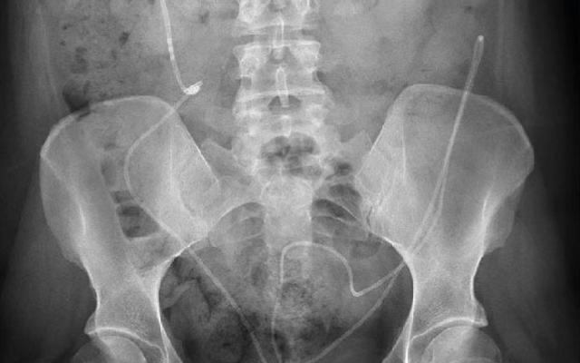 Röntgenfoto bekkengebied