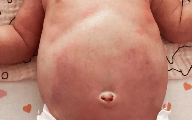 Baby met gezwollen en rode buik