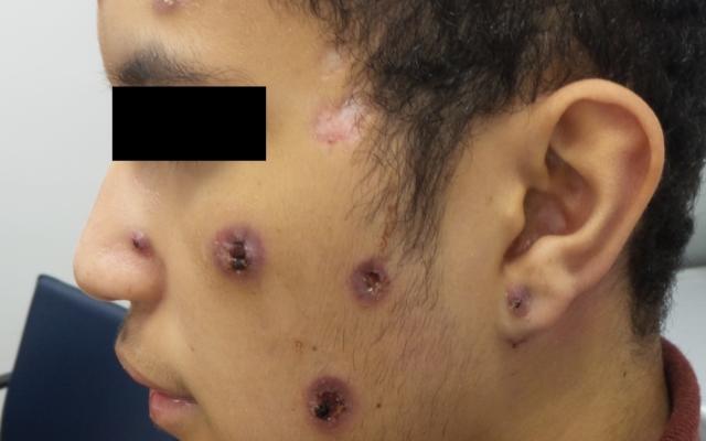 Man met putten in het gelaat.