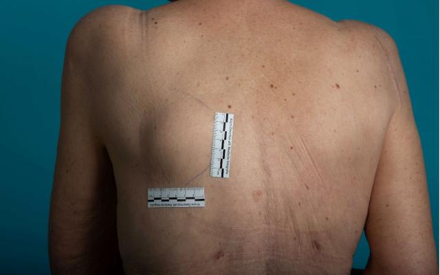 Vrouw met zwelling op haar rug