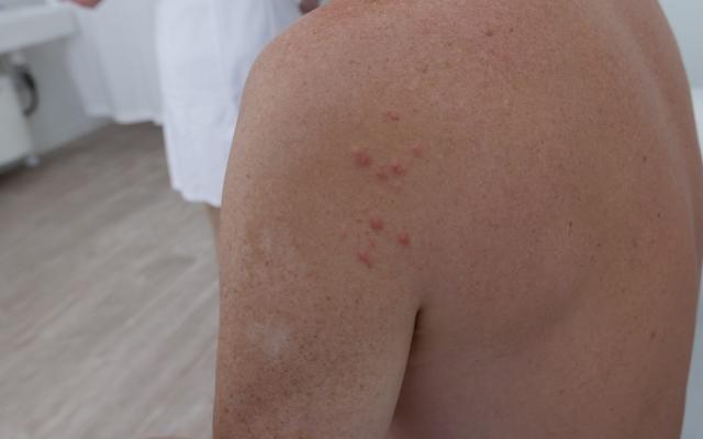 papels op de linkerschouder van een patiënt.