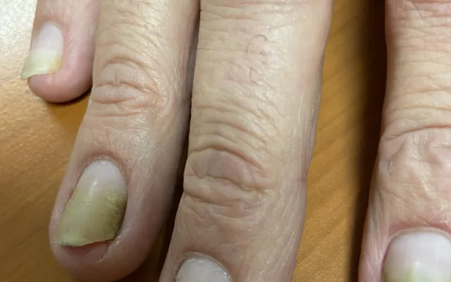 hand met gelige nagels