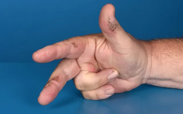 Hand met bruine vlekjes erop