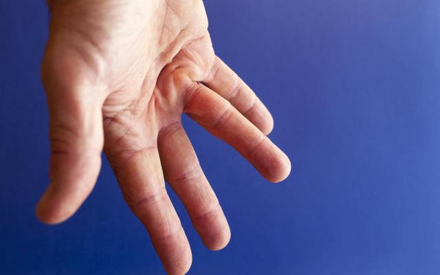 Hand met symptomen van ziekte van Dupuytren