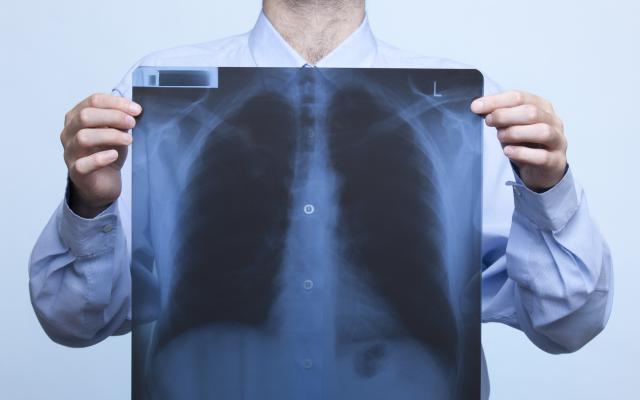 Een man die een röntgenfoto van zijn borst voor zijn borst houdt