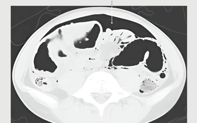 Post-mortem-CT-scan