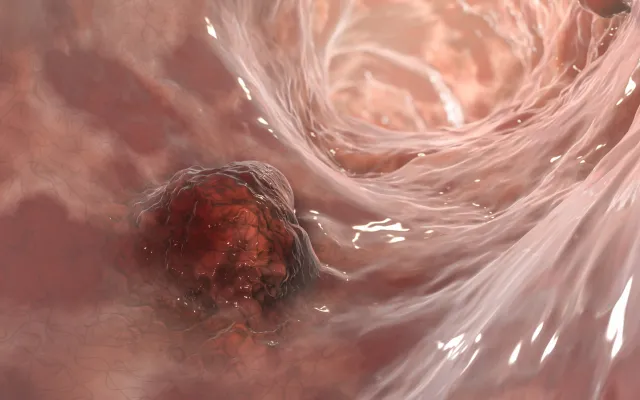 Beeld: Dr_Microbe/iStock.com Tumor in de slokdarm