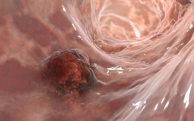 Darmkanker tumor