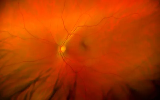 Beeld: stanley45/iStock.com Retinale vaatocclusie