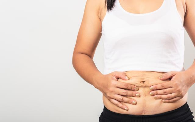 Vrouw die haar handen op een buik met litteken houdt