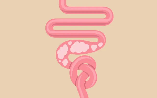 Beeld: AlonzoDesign/iStock.com Illustratie van een darmkanaal met een knoop erin.