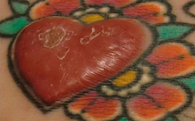 Tatoeage van een hartje waarin het midden ingekleur is met rode inkt en dat stuk huid is opgebold als allergische reactie op de rode inkt