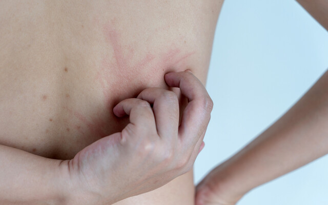 Rug met rode striemen waar de eigenaar overheen krabt.