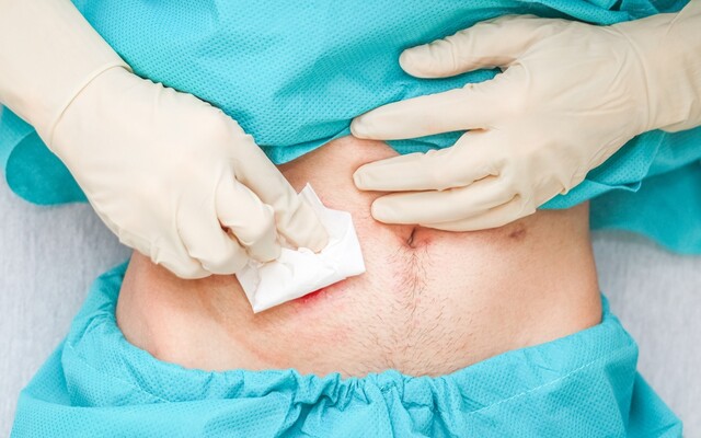 Stoma die verwijderd is