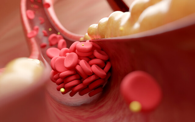 Illustratie van een vernauwde slagader door plaque